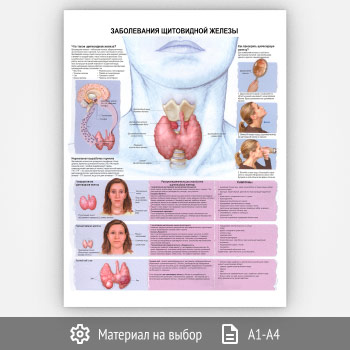 Плакат «Заболевания щитовидной железы» (ЗОЖ-36, 1 лист)